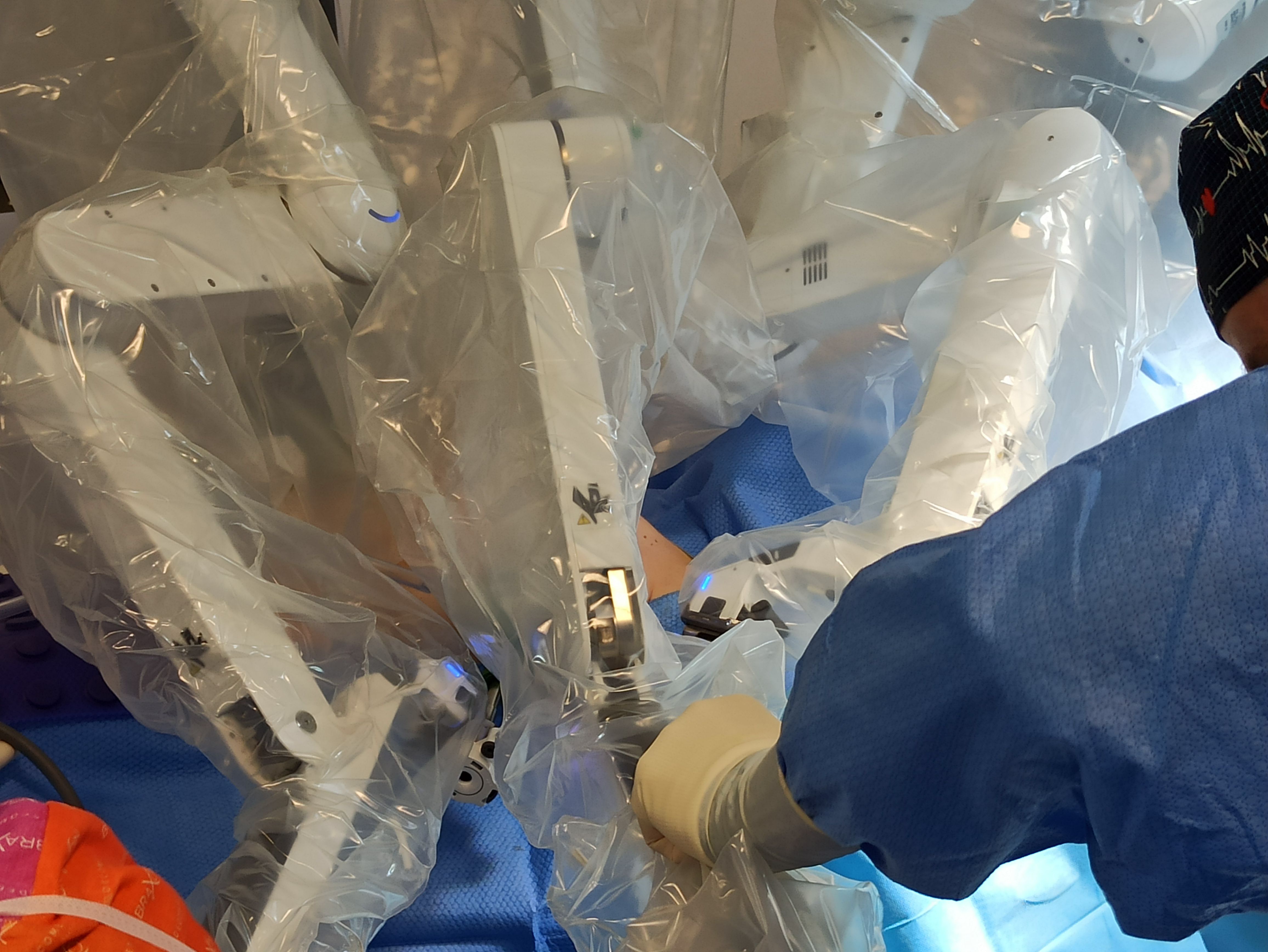 Prvi robotiziran poseg profilaktične mastektomije v deželi Furlaniji-Julijski krajini, ki ga je izvedla ekipa dr. Giuseppeja Stacula.